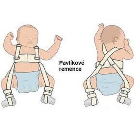 Pavlik's prosthetic cures no.2 (1-4 months)