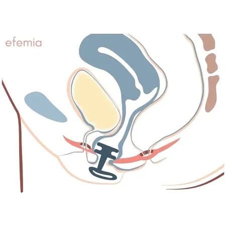 EFEMIA Pessar Insert pour incontinence féminine, 3 pcs.