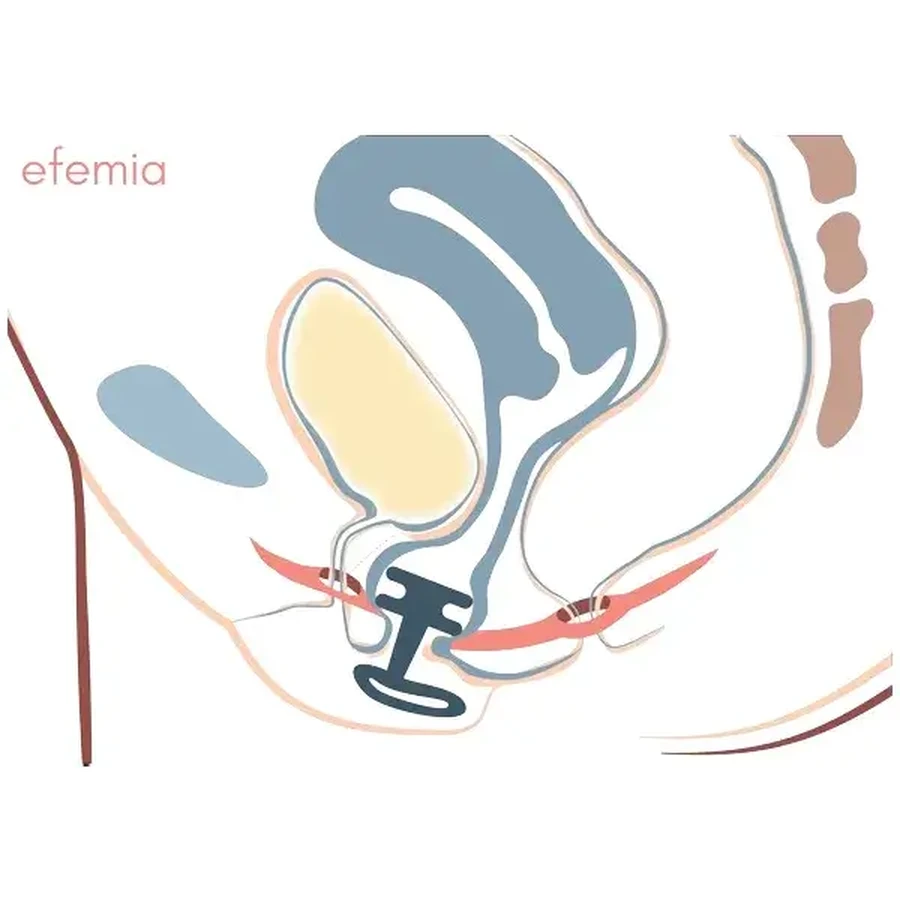 EFEMIA Pessar Insert pour incontinence féminine, 3 pcs.